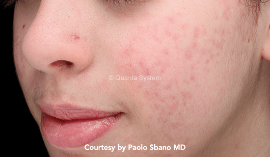 q plus acne pre img