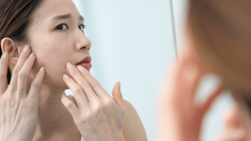 Sự bài tiết quá mức của tuyến bã nhờn mới là khởi điểm của mụn