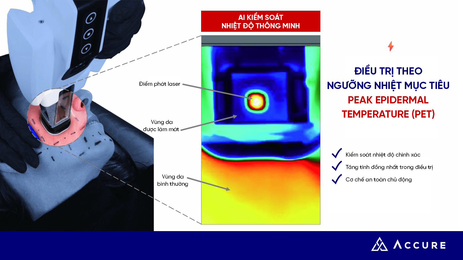 Accure Laser 1726nm: Giải pháp cho làn da dầu nhờn, mụn trứng cá và lỗ chân lông to 6 Kiểm soát nhiệt độ thông minh bằng AI và chế độ “Treat-to-Temperature”