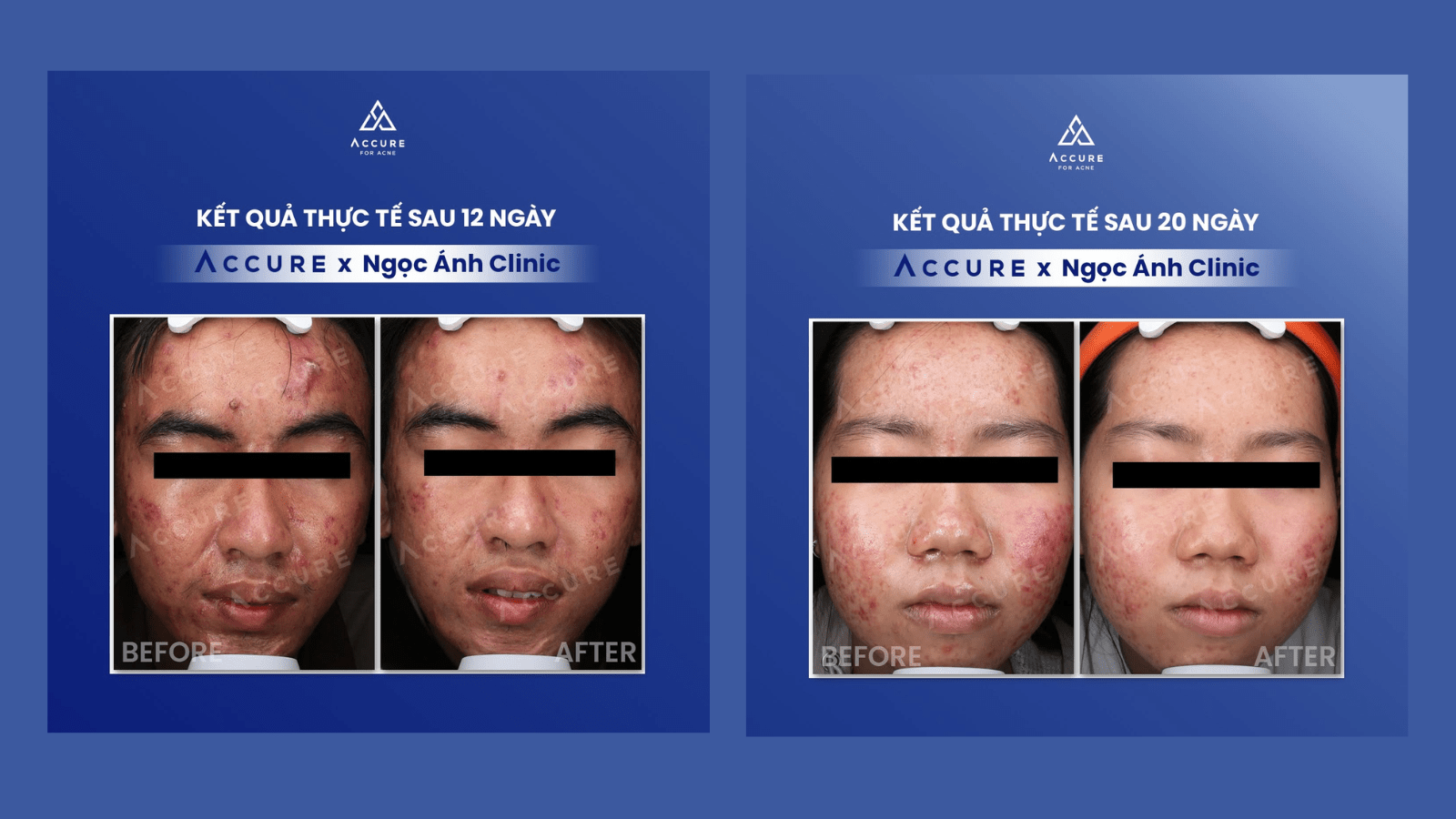 Accure Laser 1726nm: Giải pháp cho làn da dầu nhờn, mụn trứng cá và lỗ chân lông to 10 Hiệu quả điều trị mụn - Nguồn: Triung tâm Accure Laser Ngoc Anh Clinic