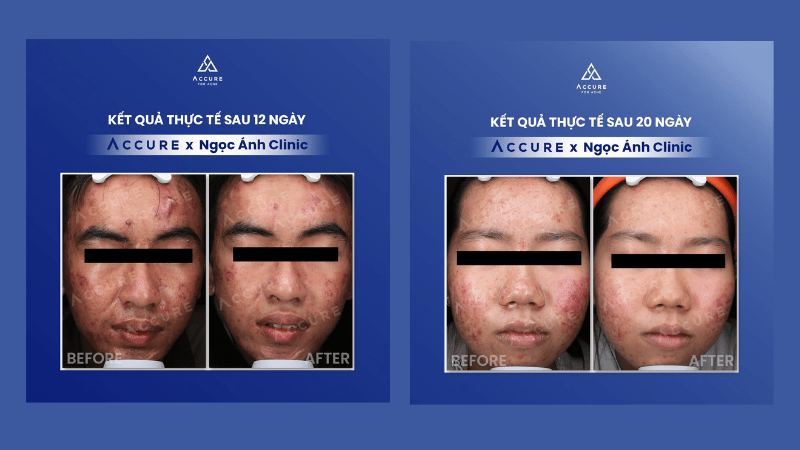 Hiệu quả điều trị mụn - Nguồn: Triung tâm Accure Laser Ngoc Anh Clinic