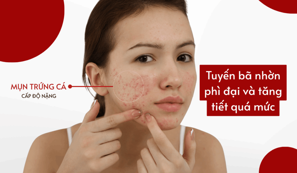 Ở cấp độ nặng, tuyến bã nhờn thường phì đại và tăng tiết quá mức