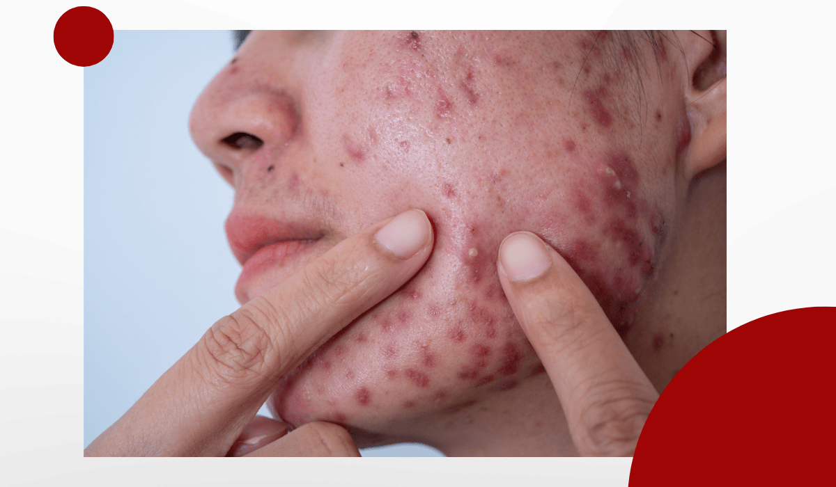 Điều trị mụn là một hành trình cần sự kiên trì
