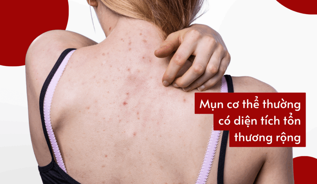 Accure Laser có khả năng phát năng lượng đồng đều trên diện tích lớn