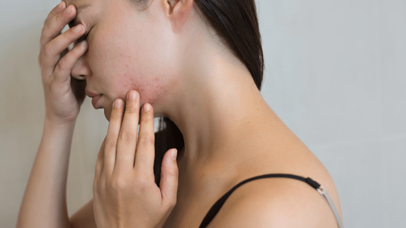 Mụn trứng cá luôn là một nỗi ám ảnh lớn đối với làn da