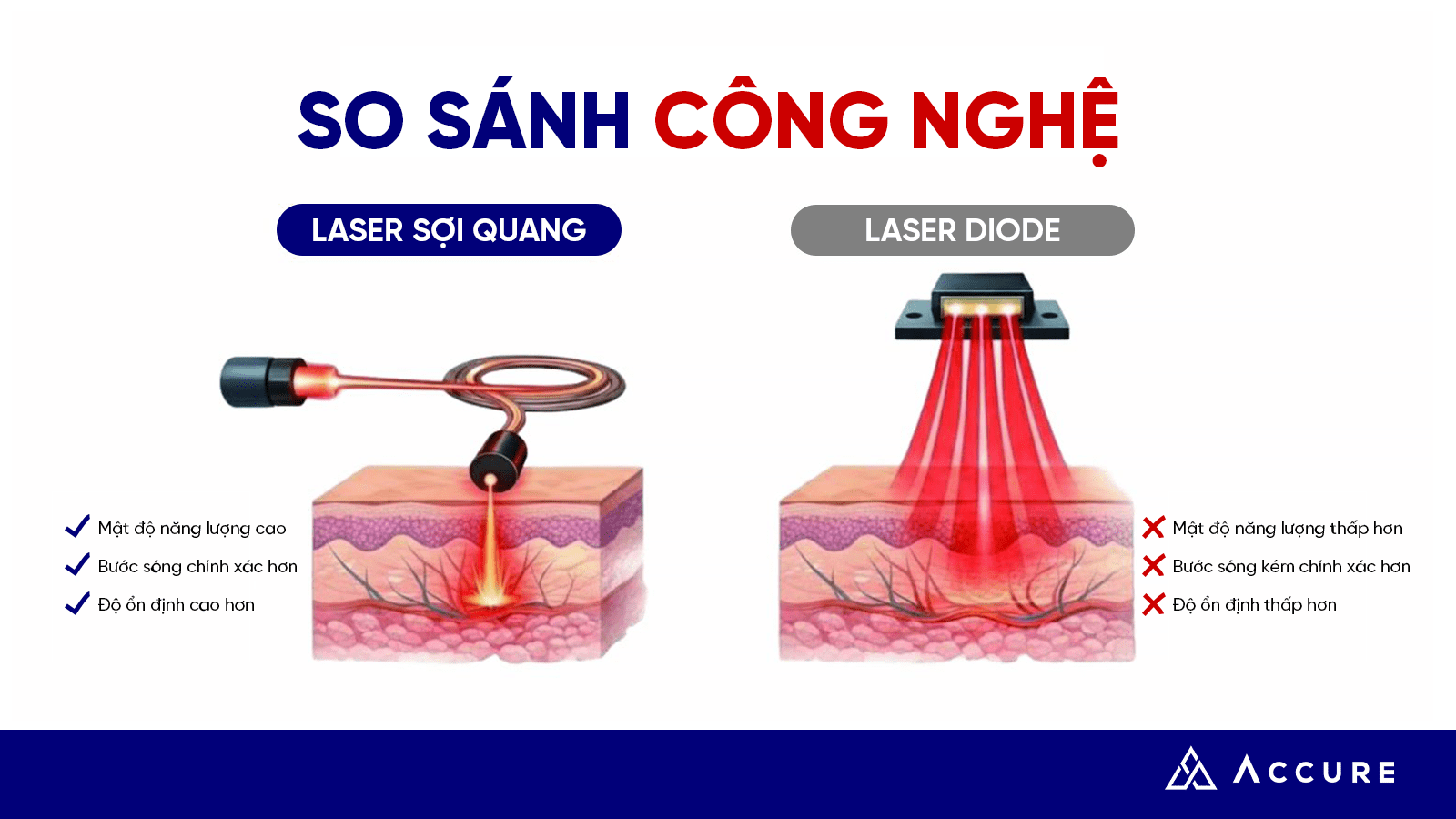 Accure Laser 1726nm: Giải pháp cho làn da dầu nhờn, mụn trứng cá và lỗ chân lông to 5 công nghệ laser sợi quang (Fiber Laser) thay vì laser diode