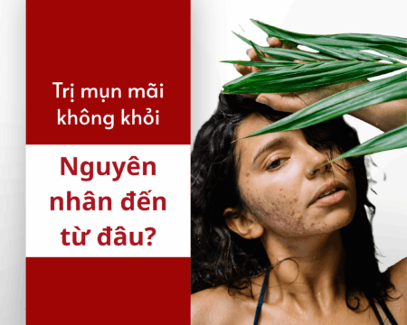 Trị mụn mãi không khỏi - Nguyên nhân do đâu?