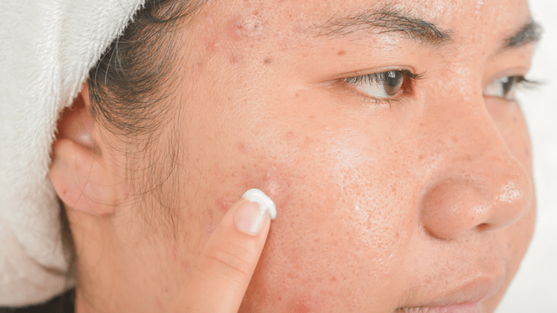 Giải pháp kiểm soát bã nhờn phổ biến hiện nay
